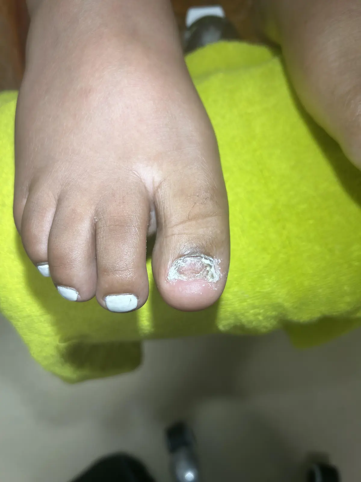 Client toenail before professional foot care